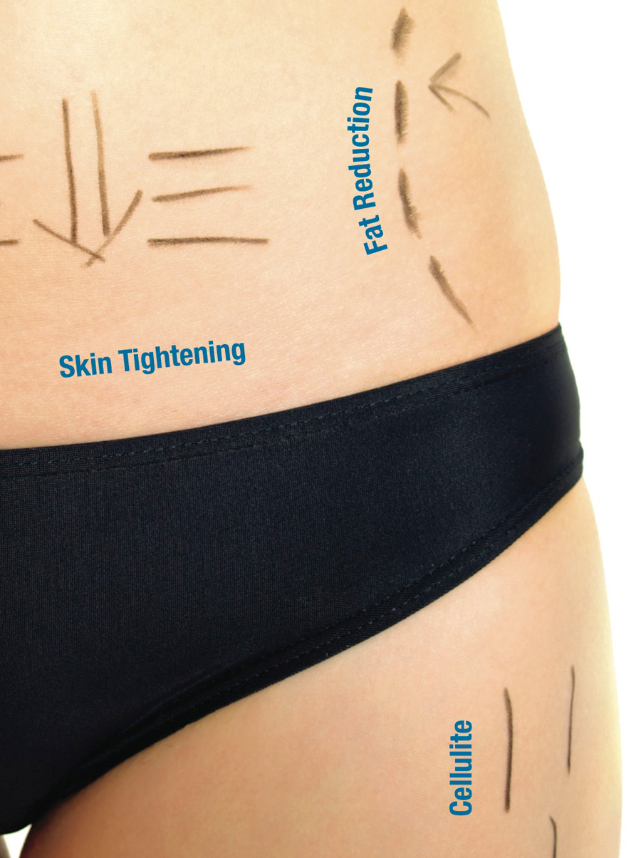 3D Lipo