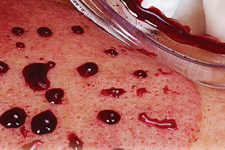 Cupping/Hijama