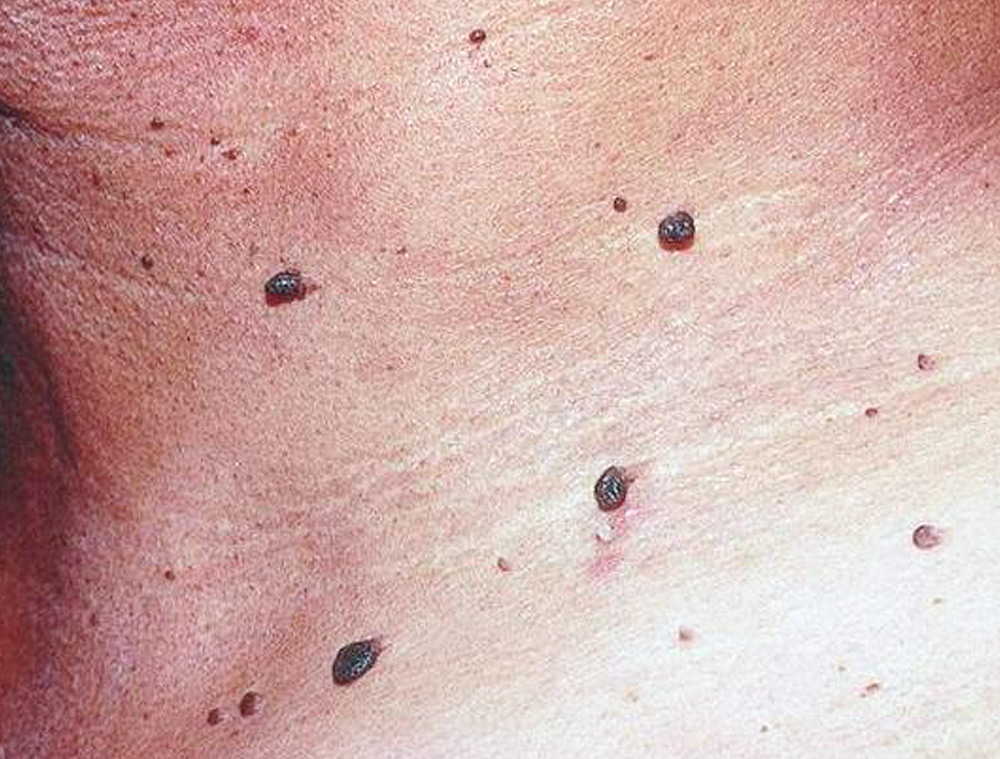 Skin Tags